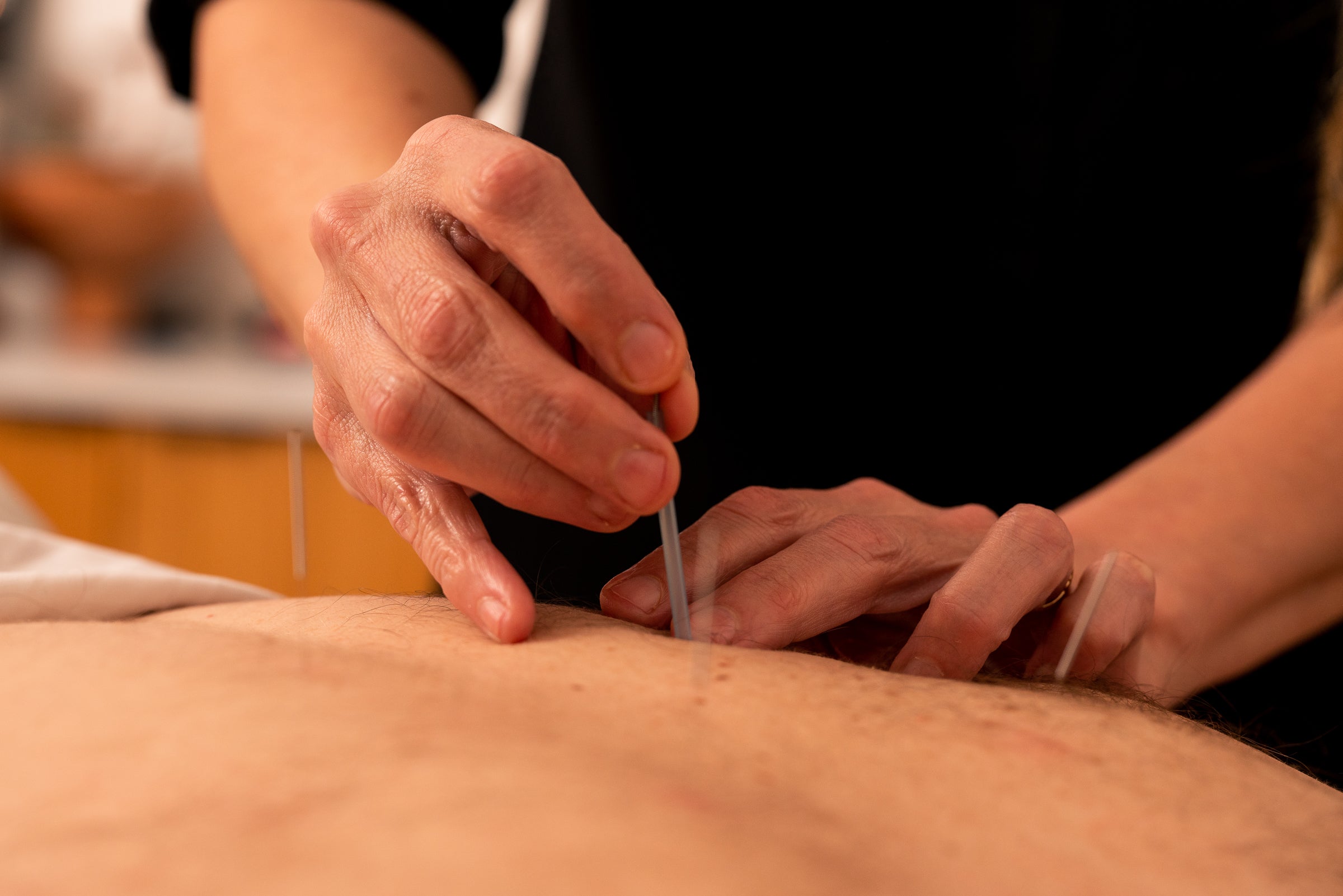 Discover Acupuncture at Alive and Well
