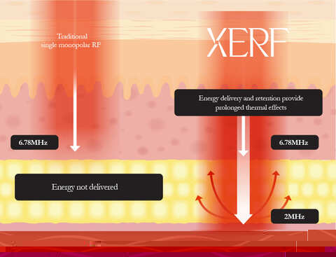 Diagram comparing traditional single-frequency radiofrequency to XERF's dual-frequency energy delivery