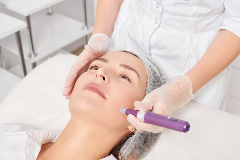 Microneedling